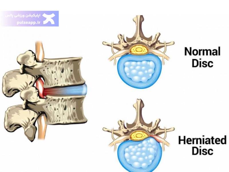 علائم دیسک کمر