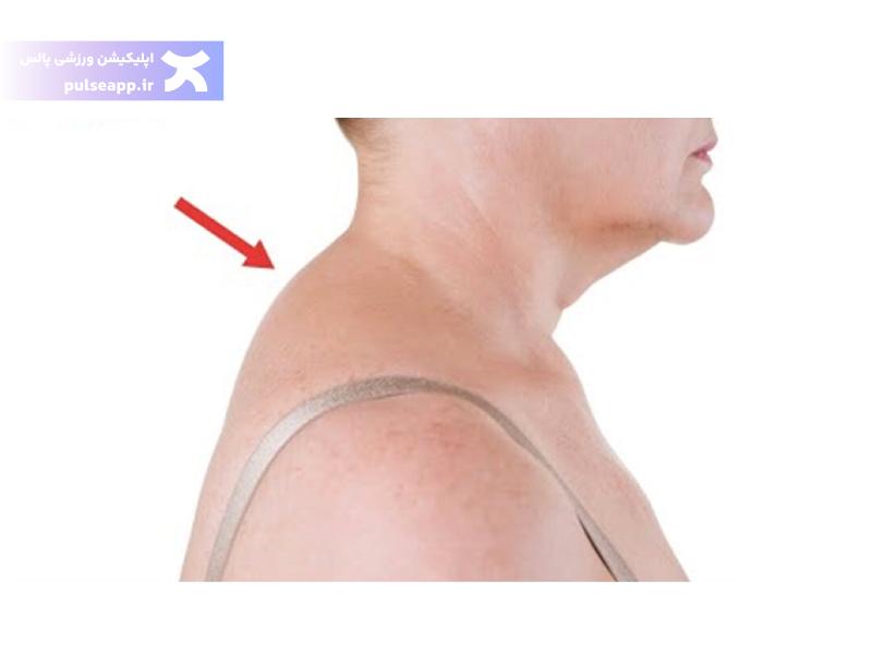 تصویر ورزش برای از بین بردن چربی پشت گردن؛ تمرینات ساده برای خانه و باشگاه