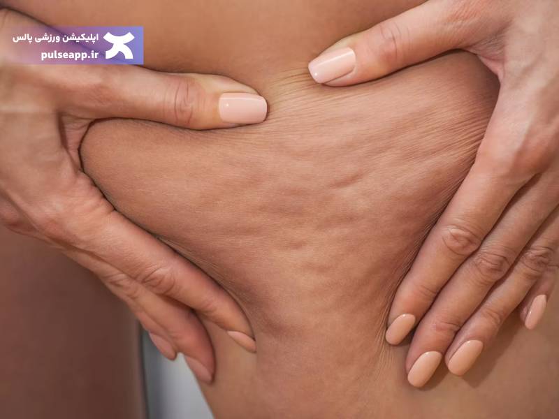 تصویر ورزش برای سلولیت پشت ران؛ حرکت‌های مفید و برنامه تمرینی